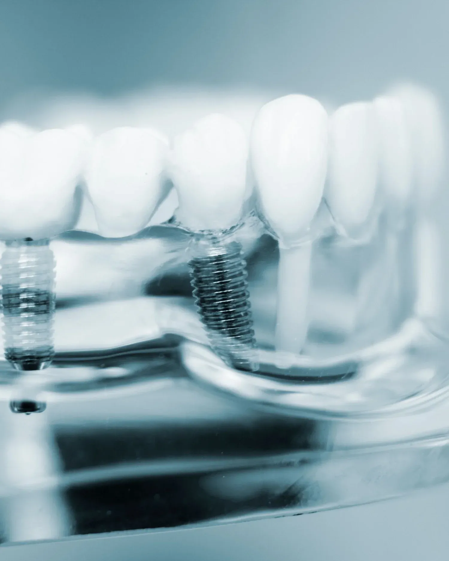 Dental Implants at e.s.i. Healthy Dentistry