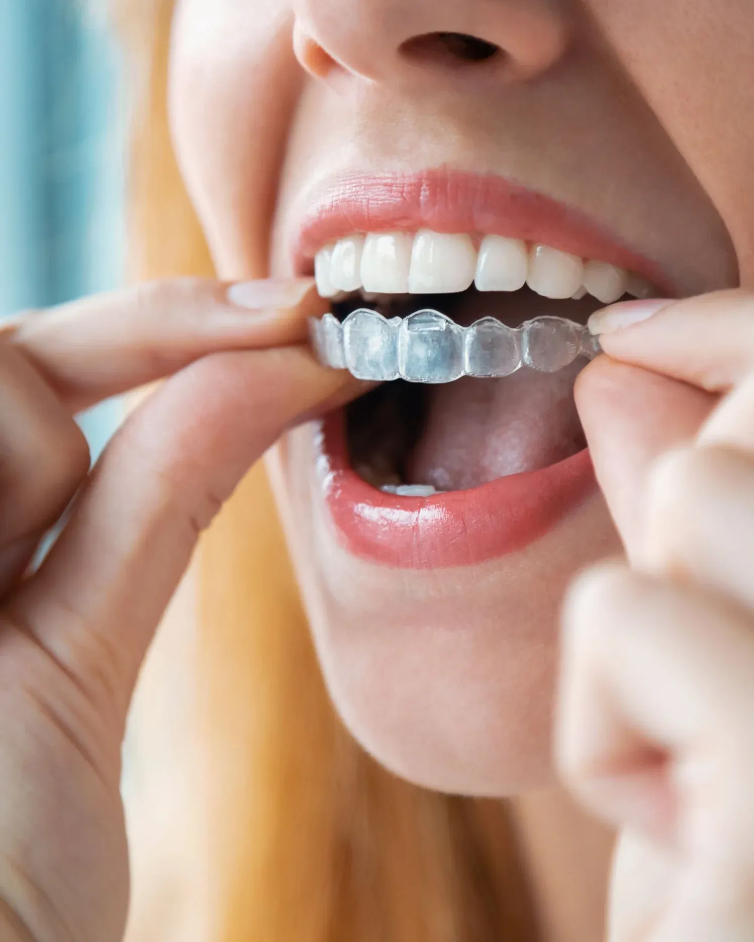 Invisalign at e.s.i. Healthy Dentistry